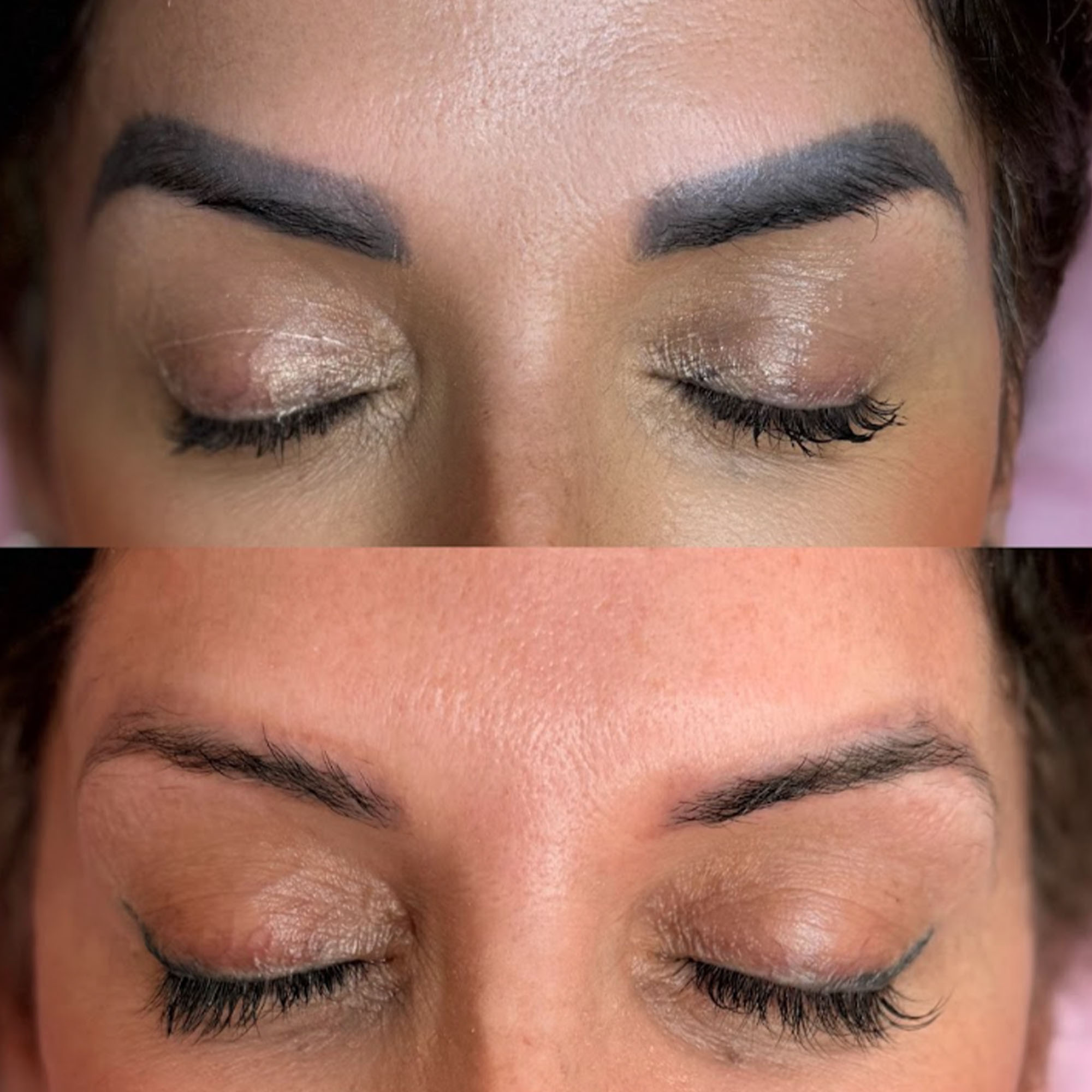 Correción de pigmentos con lasér en Madrid - Sophie Lin Beauty
