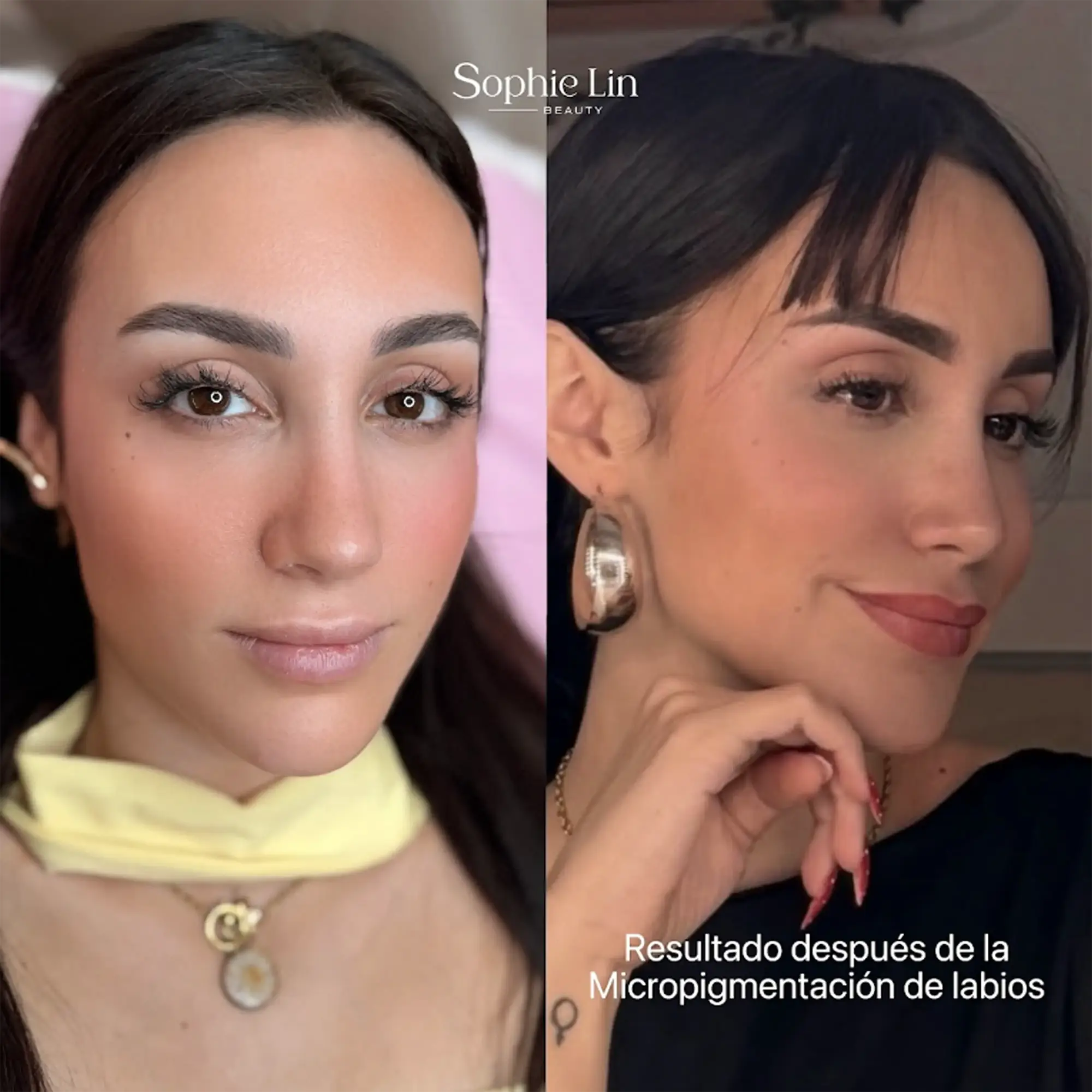 Resultados Micro Lips - Sophie Lin Beauty