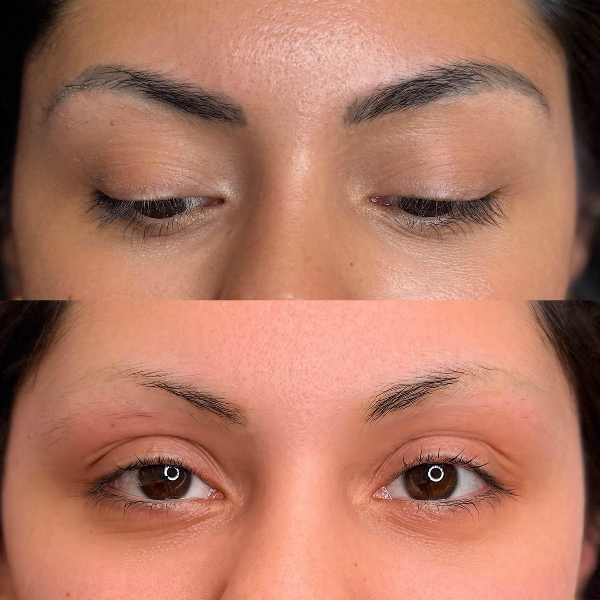Resultados reales de eliminacion de pigmentos con láser - Sophie Lin Beauty